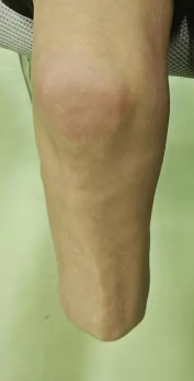 穿戴假肢后肌肉萎縮怎么辦？