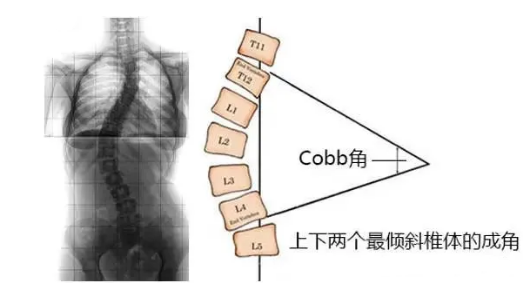 脊柱側(cè)彎角度怎么測(cè)量？